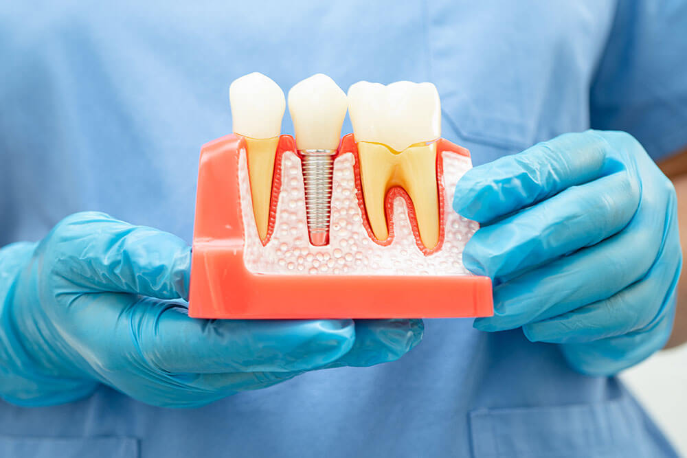 Dental Implants Roanoke & Christiansburg